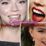 Anya Taylor-Joy botox nose job lips