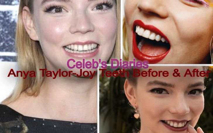 Anya Taylor-Joy botox nose job lips