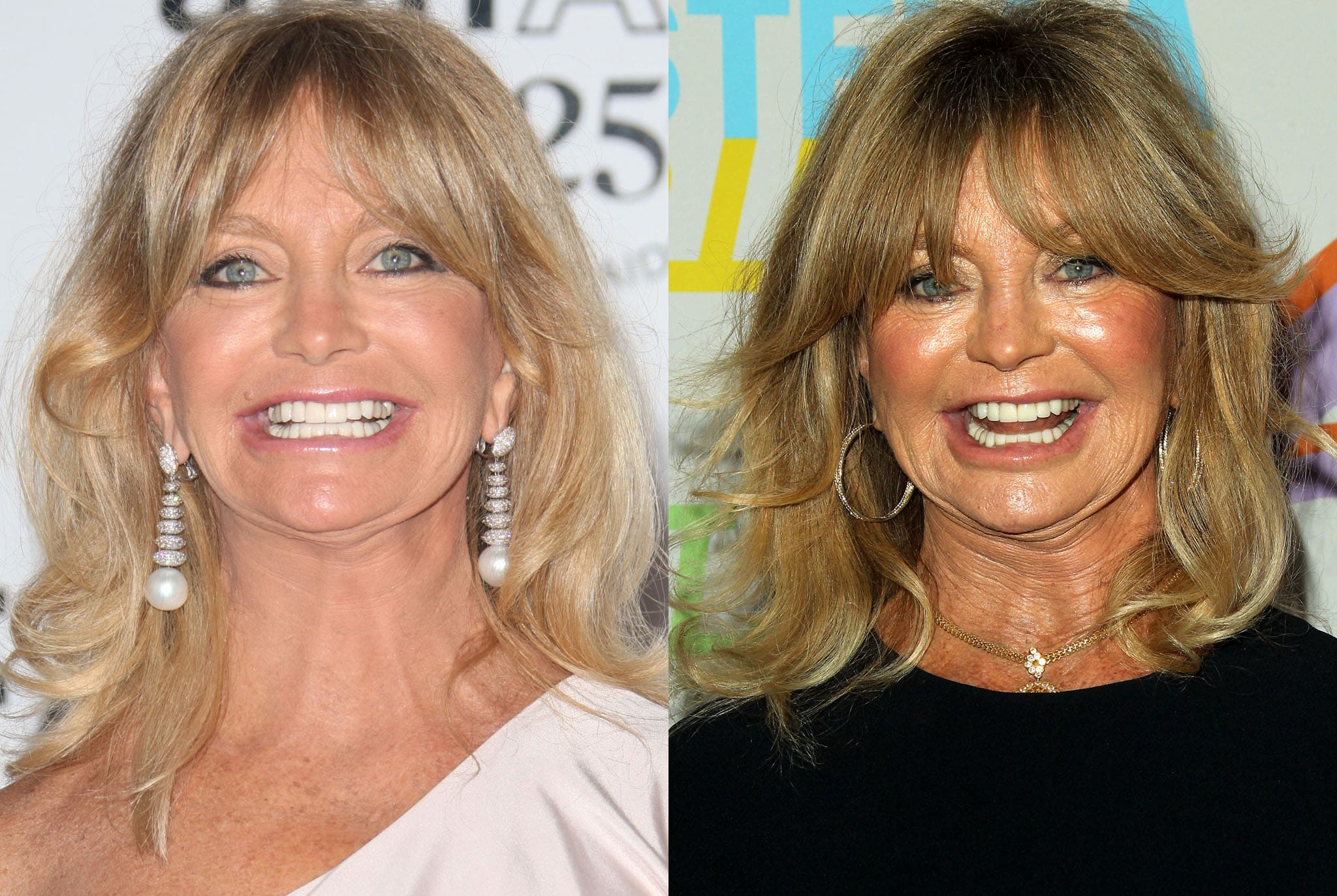 Goldie Hawn botox