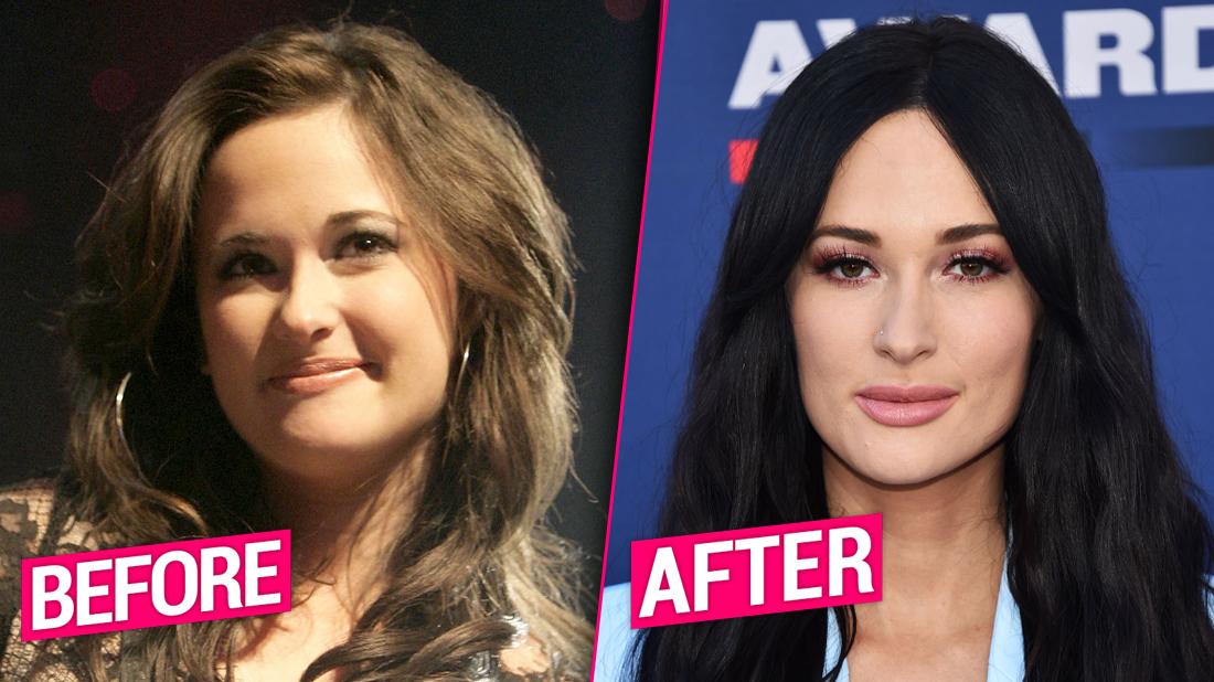 Kacey Musgraves plastic surgery