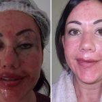 Lisa Appleton facelift lips boob job