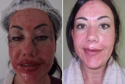 Lisa Appleton facelift lips boob job