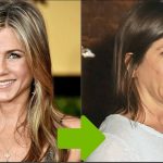 Jennifer Aniston Plastic Surgery Procedures