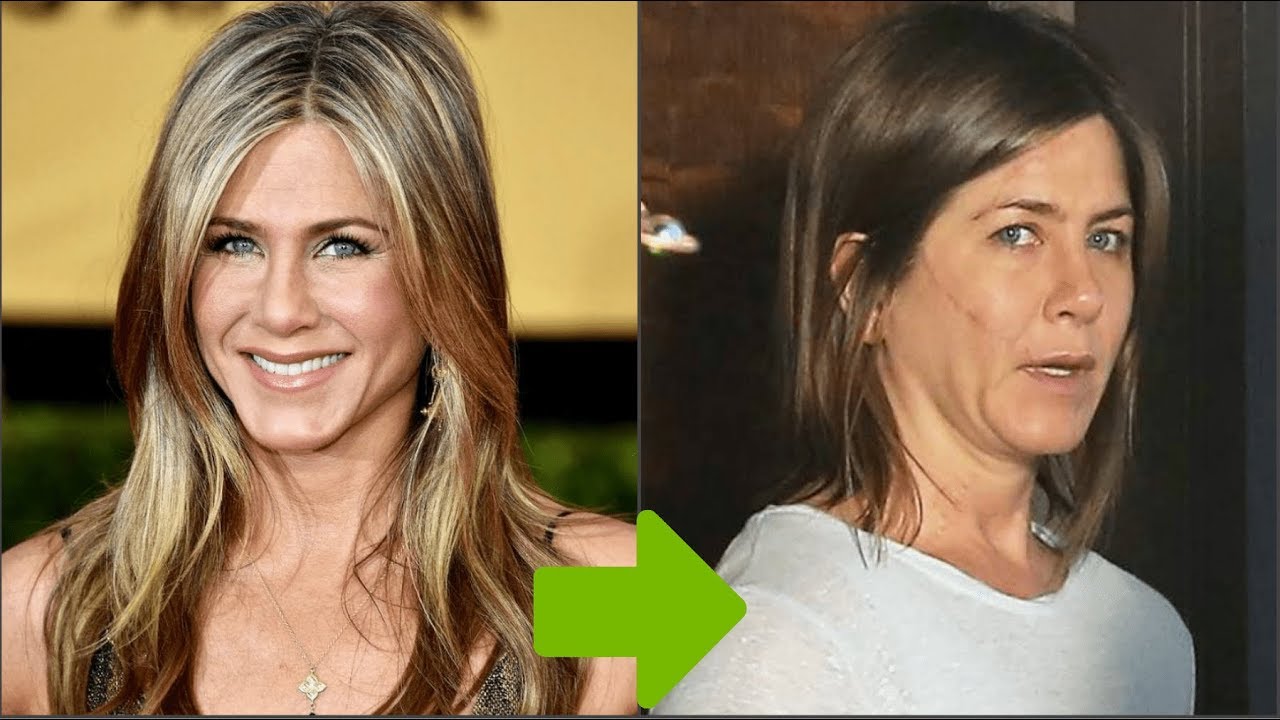 Jennifer Aniston Plastic Surgery Procedures