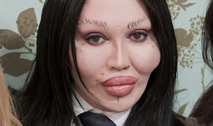 Pete Burns’ Journey Through Plastic Surgery: Nose Jobs and More
